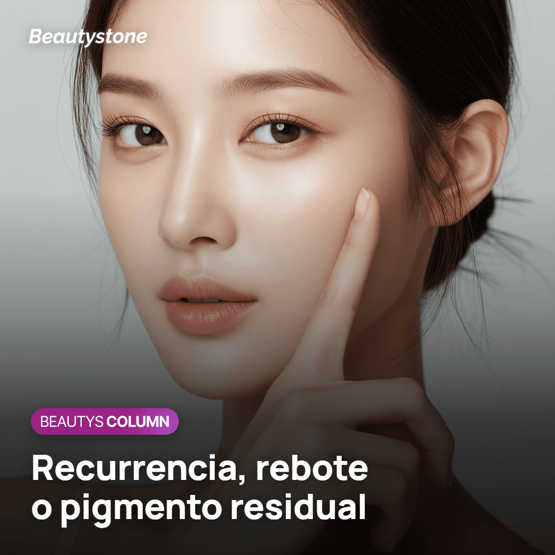 Melasma* que reaparece en los pómulos tras el láser toning