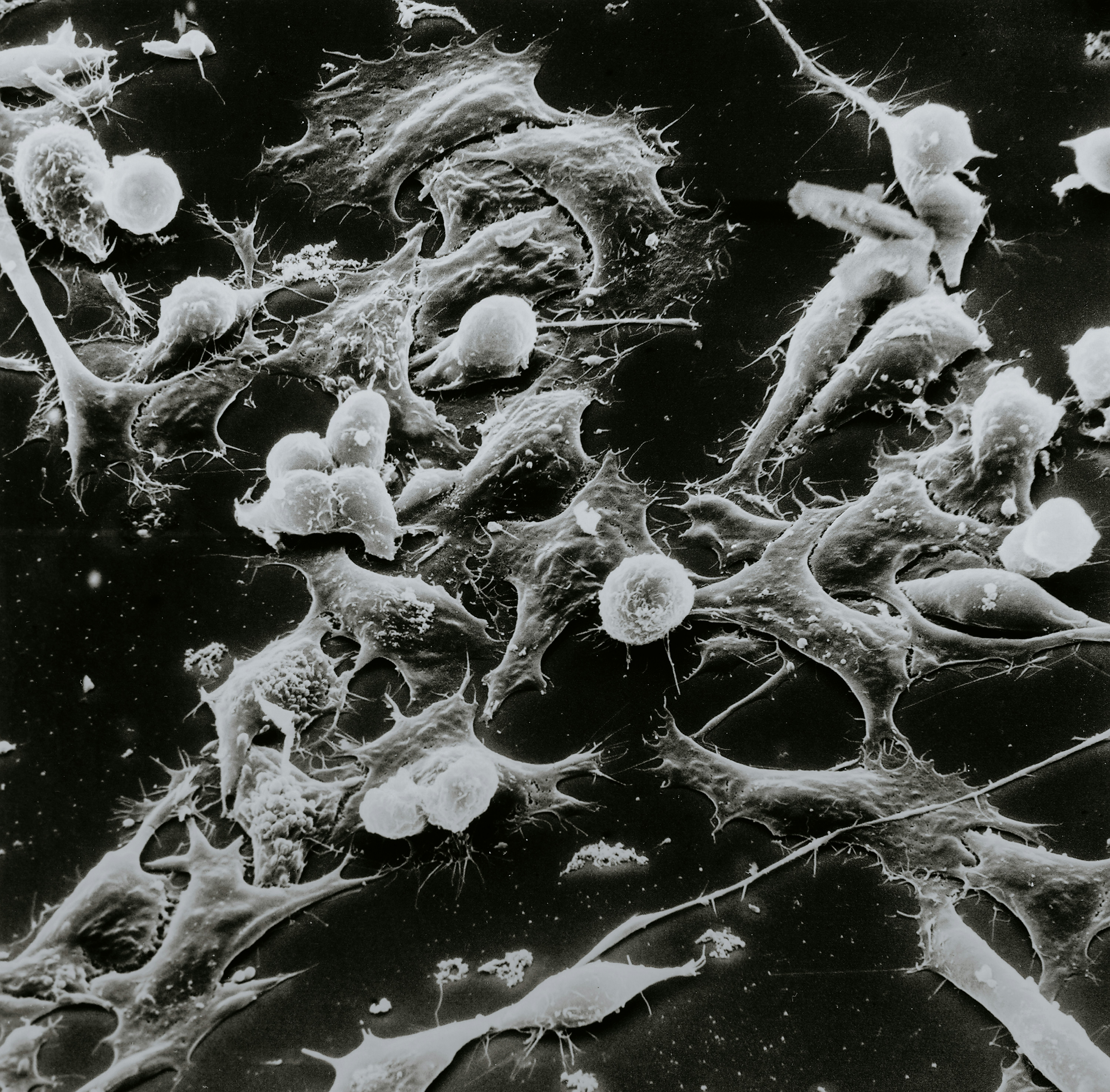 Oral Cancer Screening Guidelines - Oral Cancer Microscopic Biopsy Image