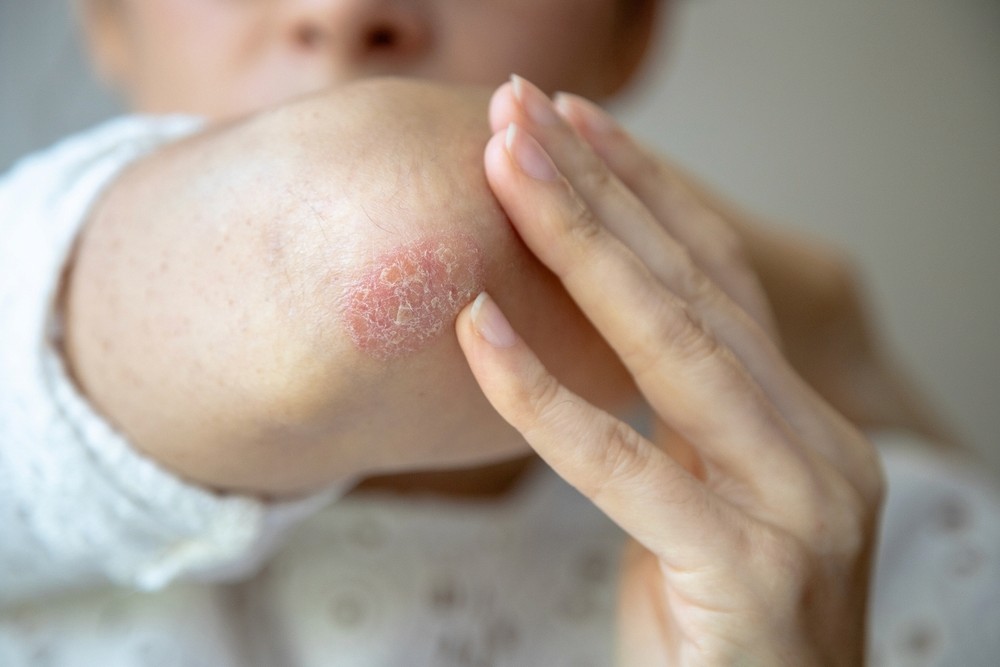 Psoriasis