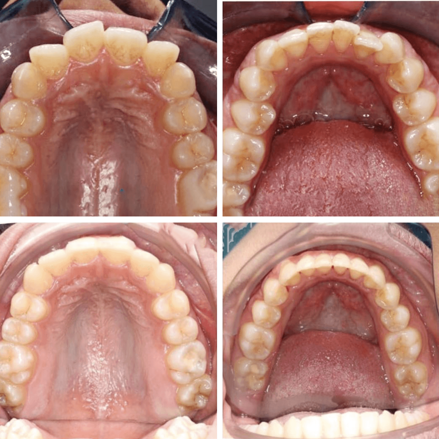 Invisalign® before and after photo from Invisalign Center in Dubai showing a clear transformation and correction of an open bite.