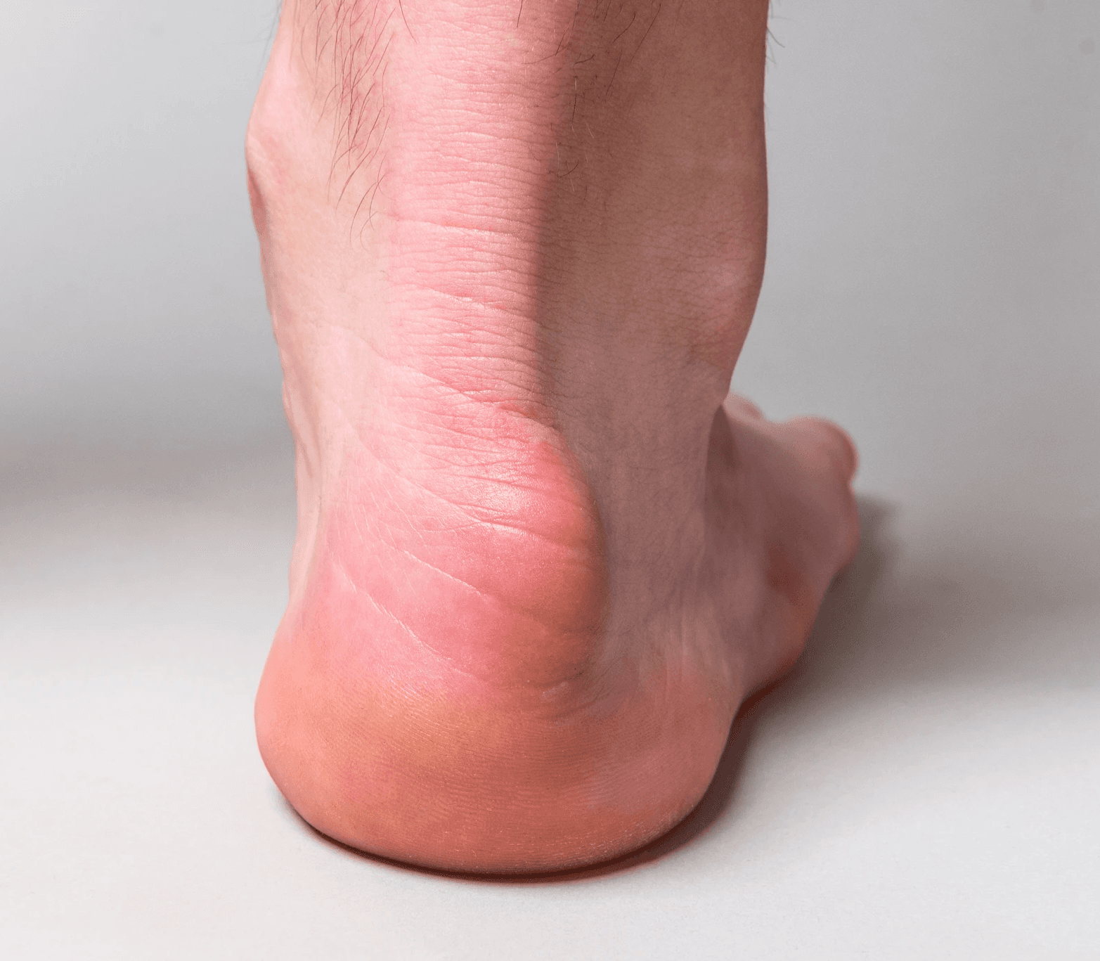 tendinite du tendon d'achile