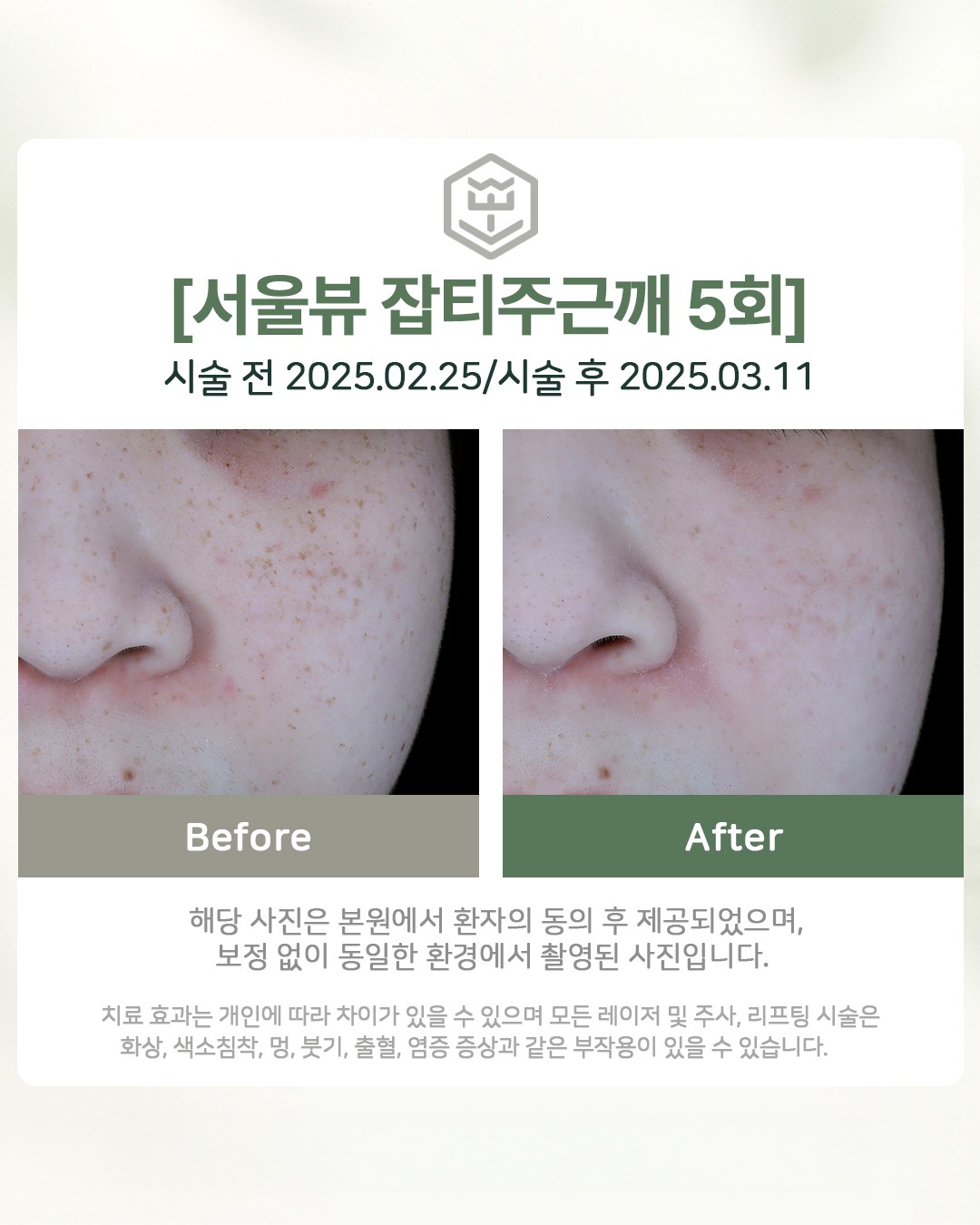 잡티주근깨 5회