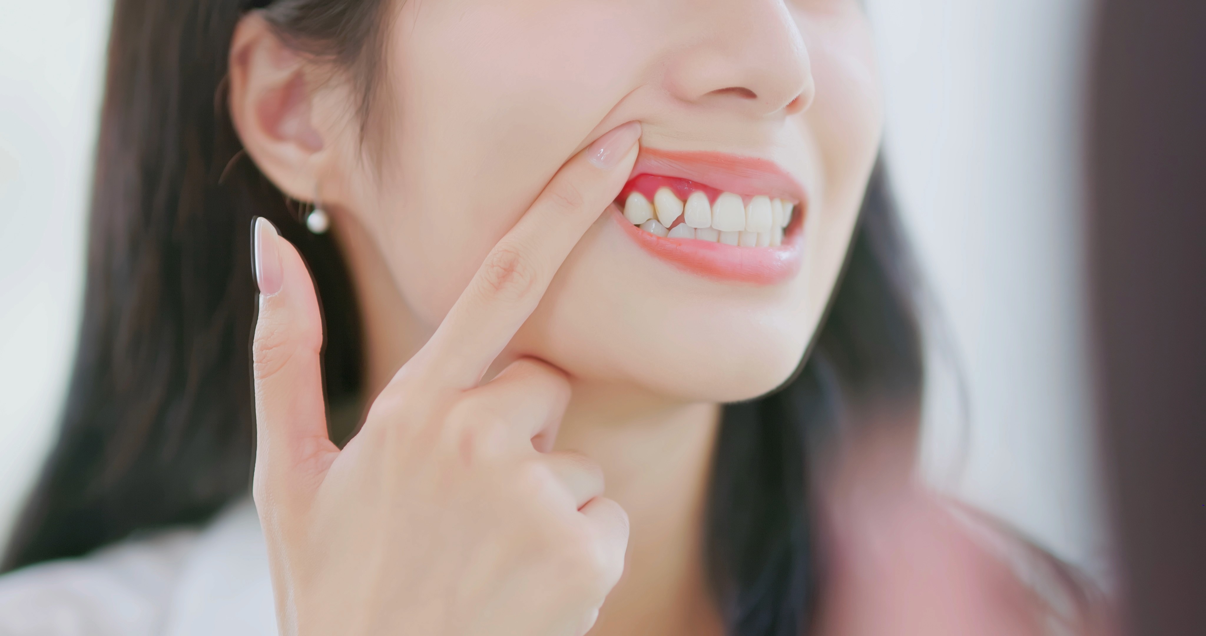 A woman is showing her teeth and gums, pointing to her gums, illustrating the importance of gum treatment for maintaining oral health.