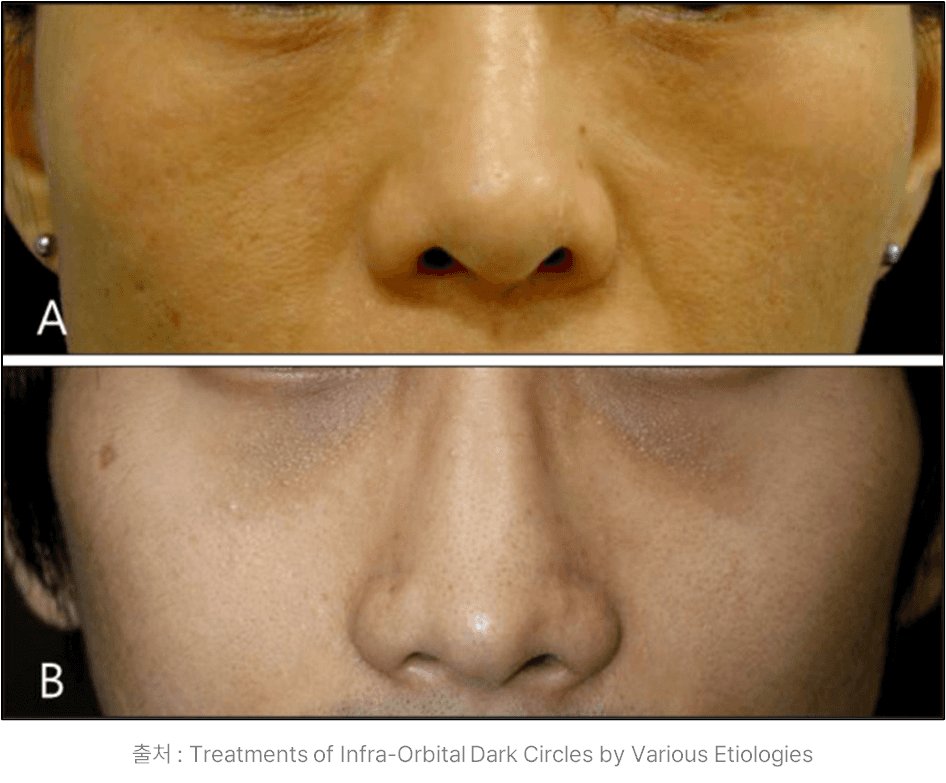 pigmented dark circles examples