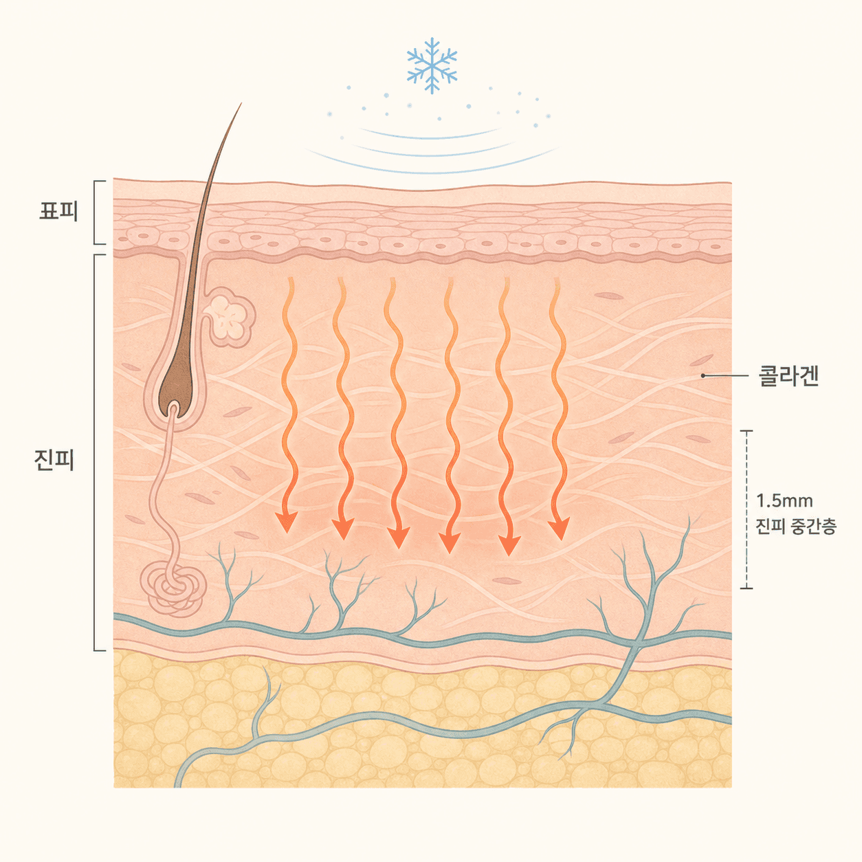 표면은 식히고 진피에 열을 전하는 마이크로웨이브의 원리