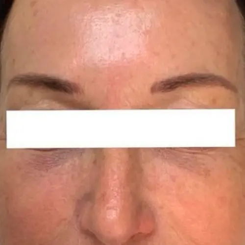After microneedling anti-aging treatment at The Vancouver Aesthetician — fine lines smoothed, skin looking visibly younger, healthier, and rejuvenated