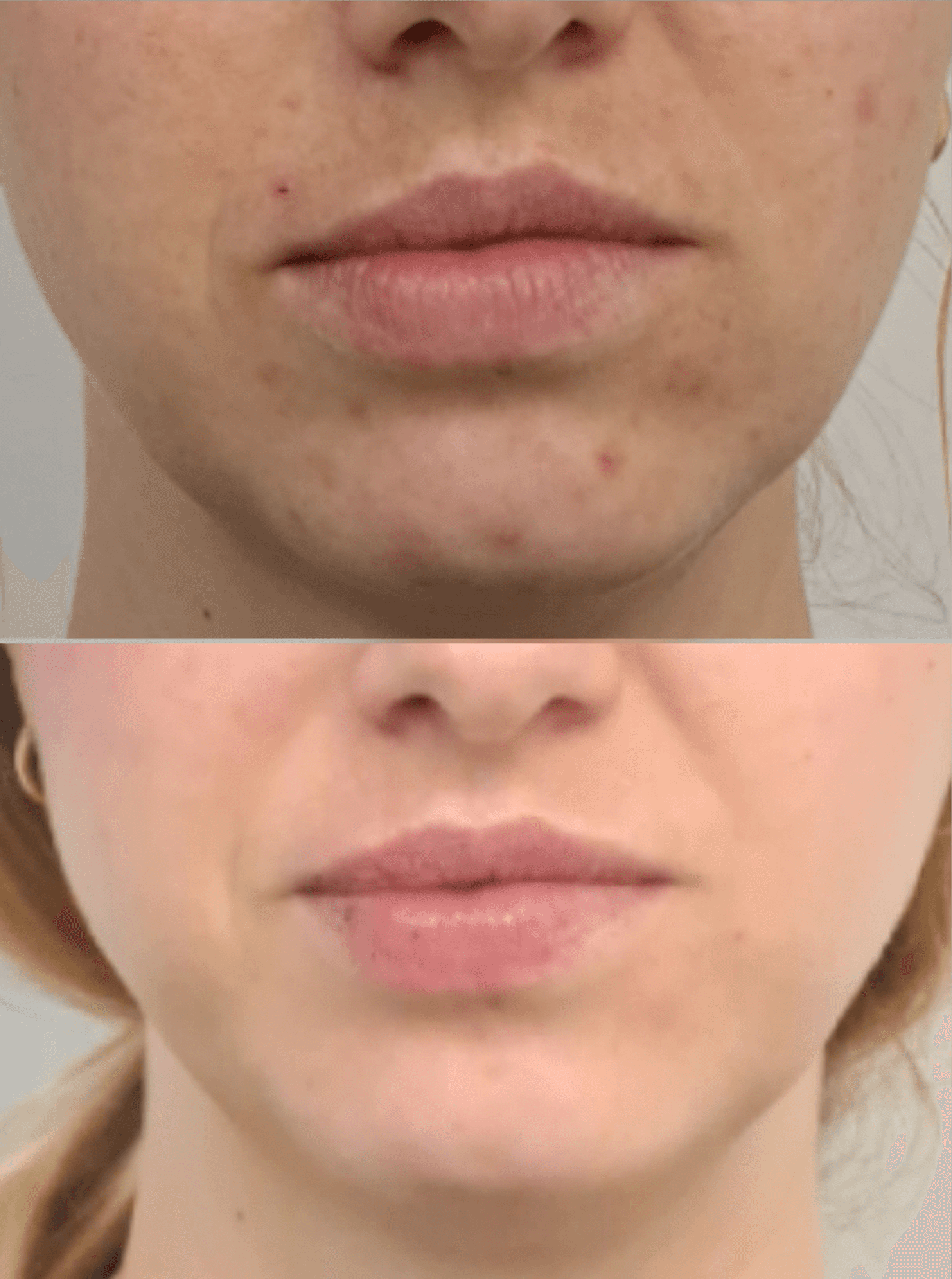 Neurolifting leszczenko_estGen_naturalny_lifting_bez_skalpela_szczecin_wrocÅaw_zabiegi_na_traÌ¨dzik_na_chomiczki