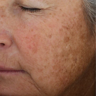 Before brightening treatment at The Vancouver Aesthetician — visible melasma and sun damage causing uneven dark patches on skin
