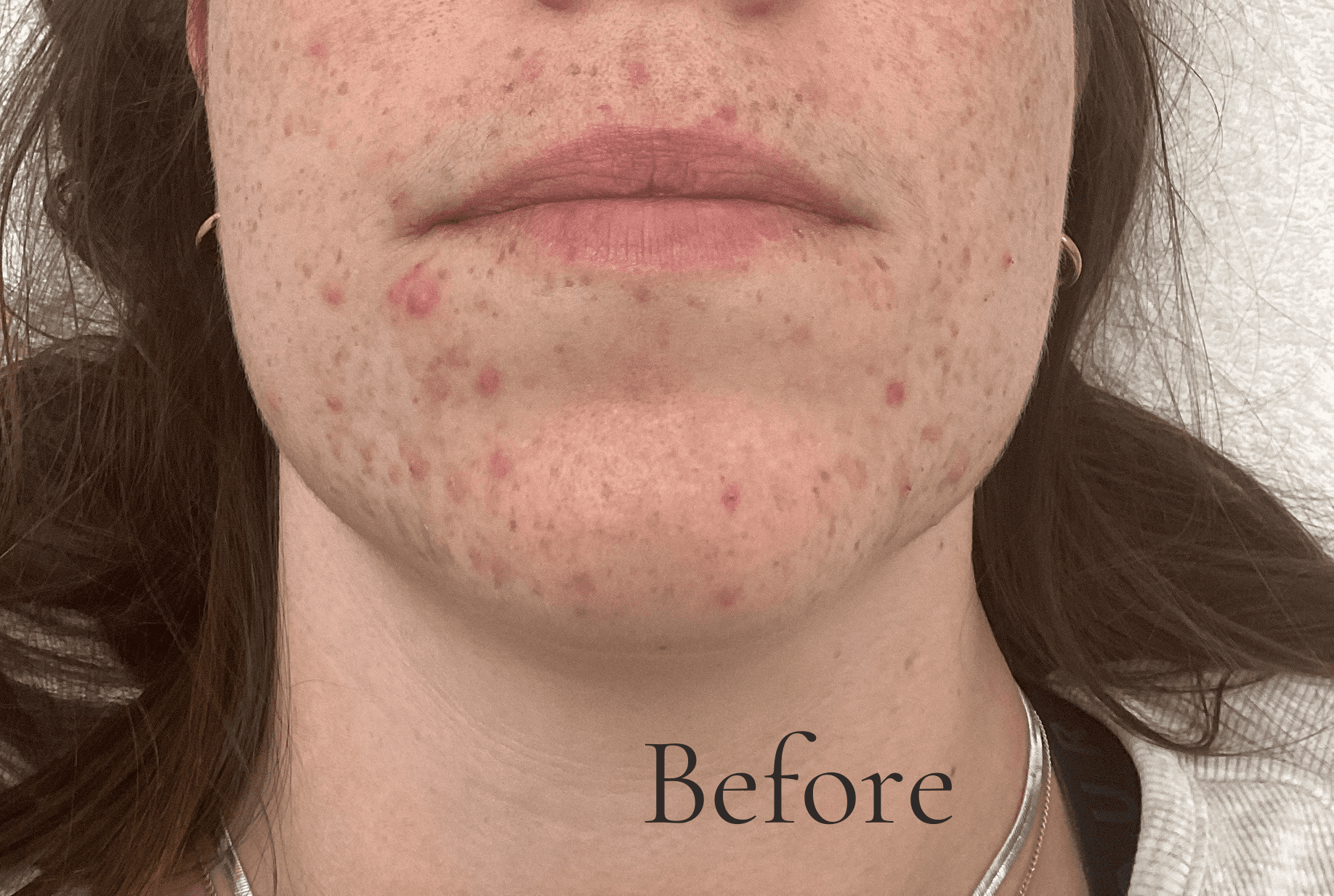 Close-up of acne on chin and mouth area