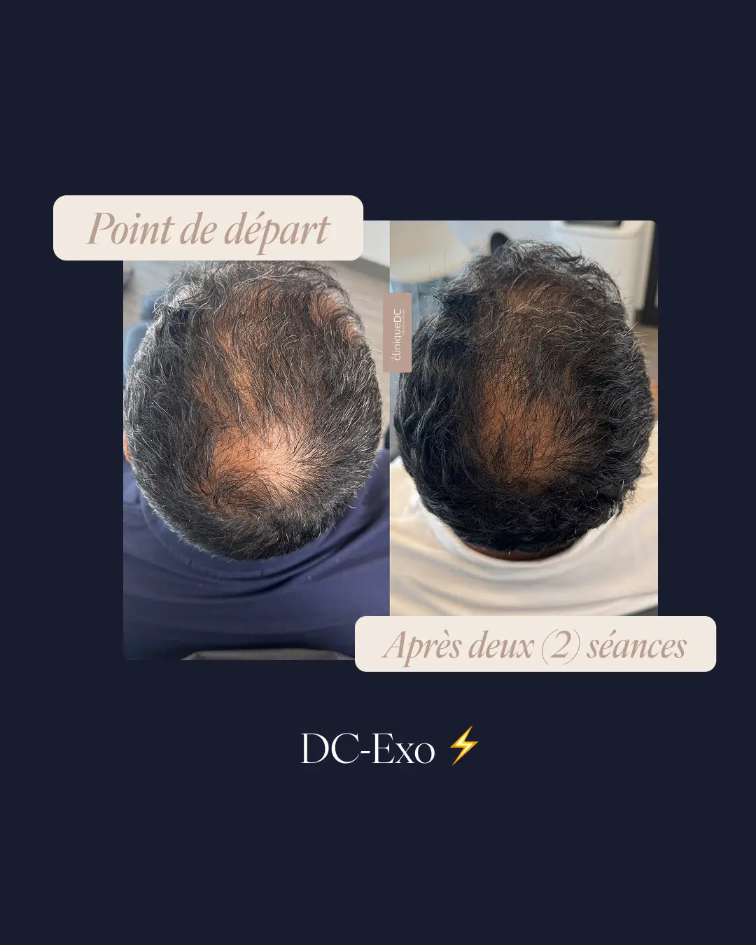 une photo du vortex du front d'un avant-après prp exosome perte de cheveux a laval dans une clinique medico-esthetique