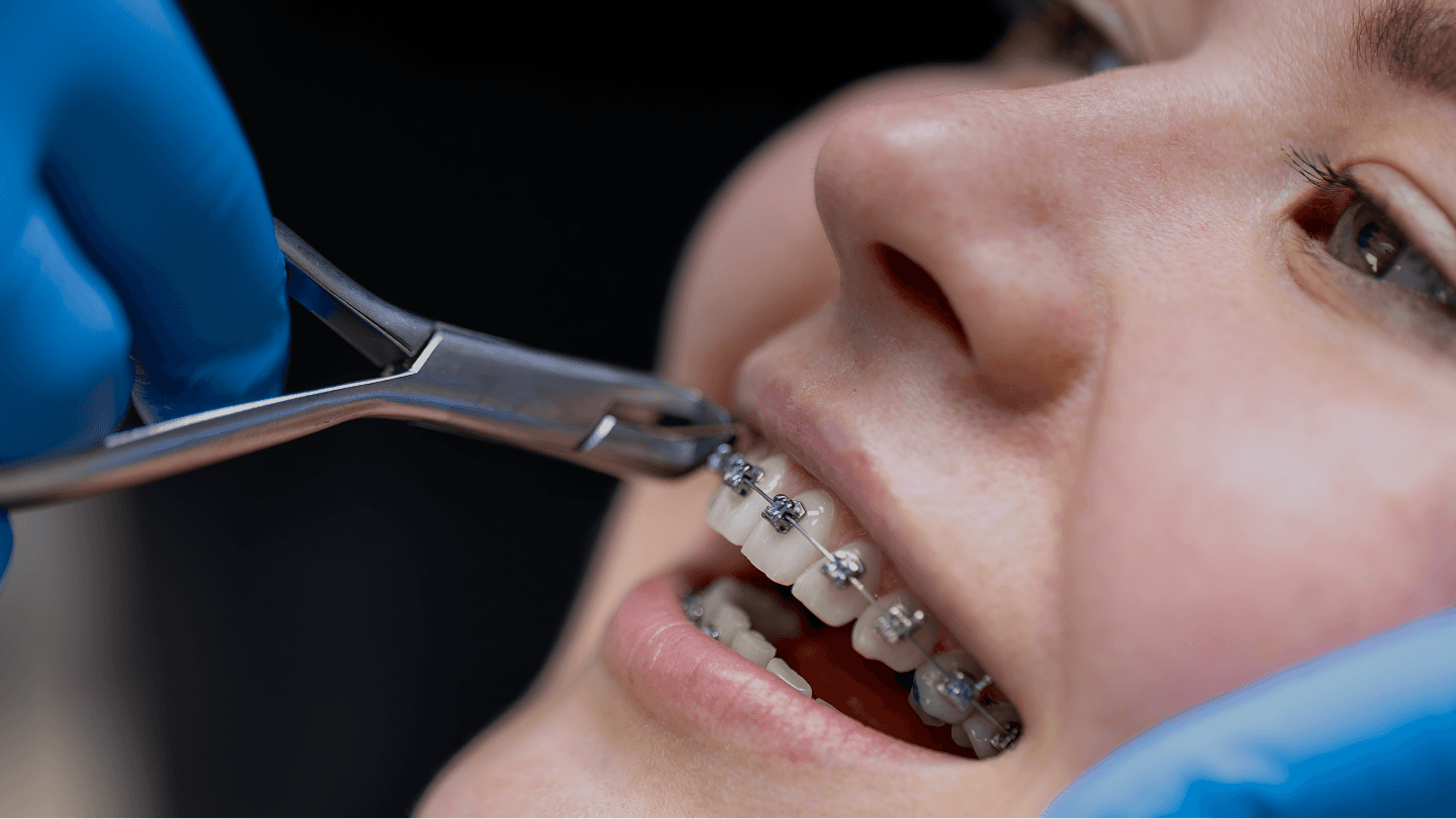 Dental Implants