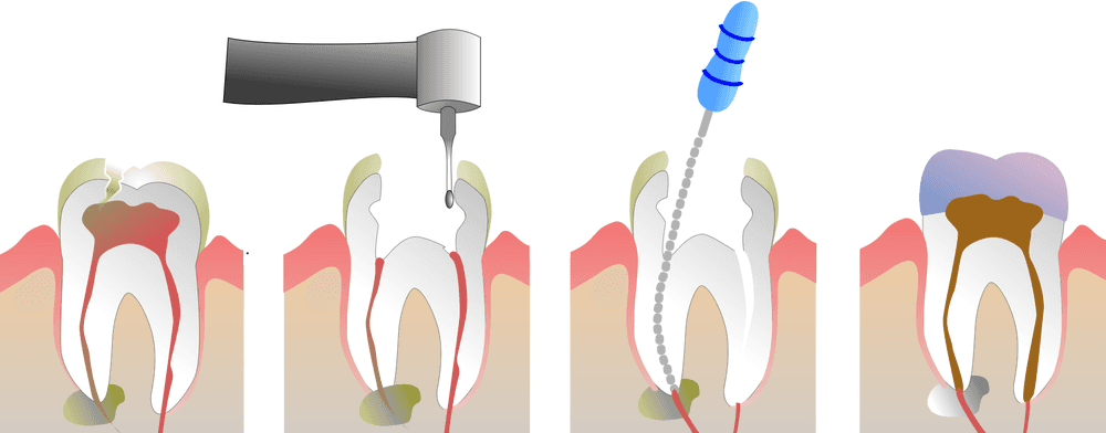 Root Canal Treatment