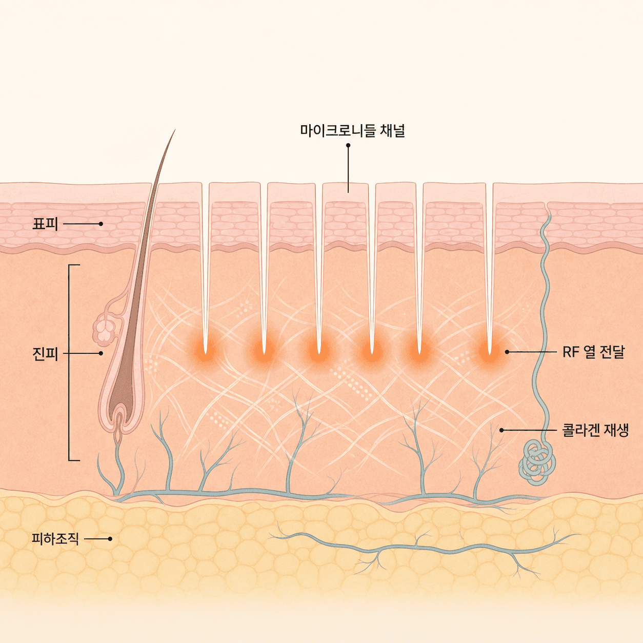 마이크로니들 RF가 표피부터 진피까지 채널을 열고 콜라겐 재생을 시작하는 구조
