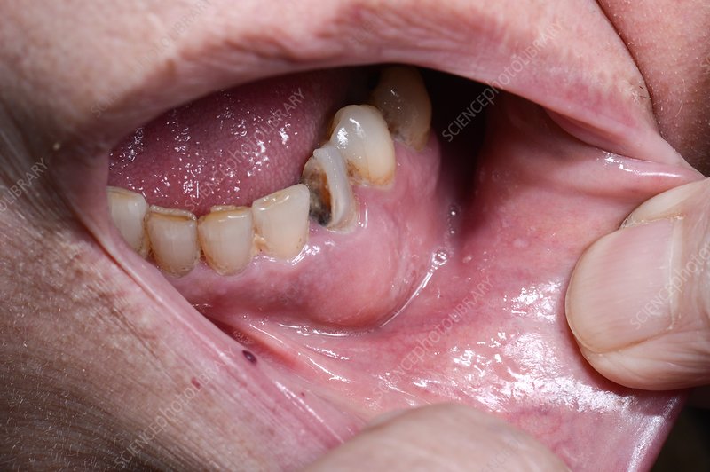 Dental Abscess