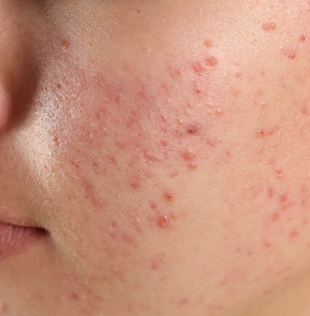 Mild to Moderate Acne Treatments