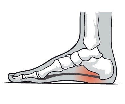 Plantar Fasciitis image showing source of pain