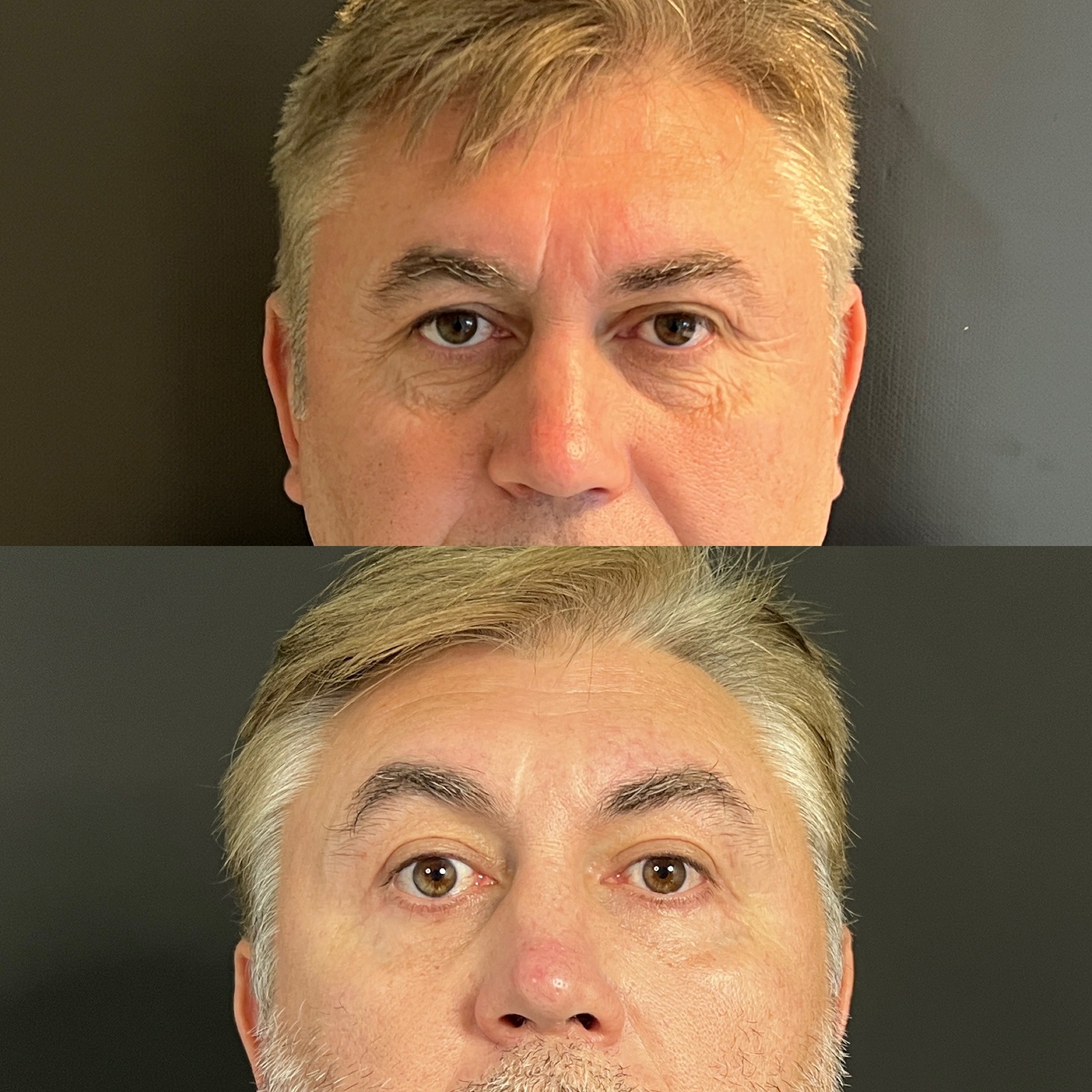 upper and lower blepharoplasty before after 1 month post-op front view