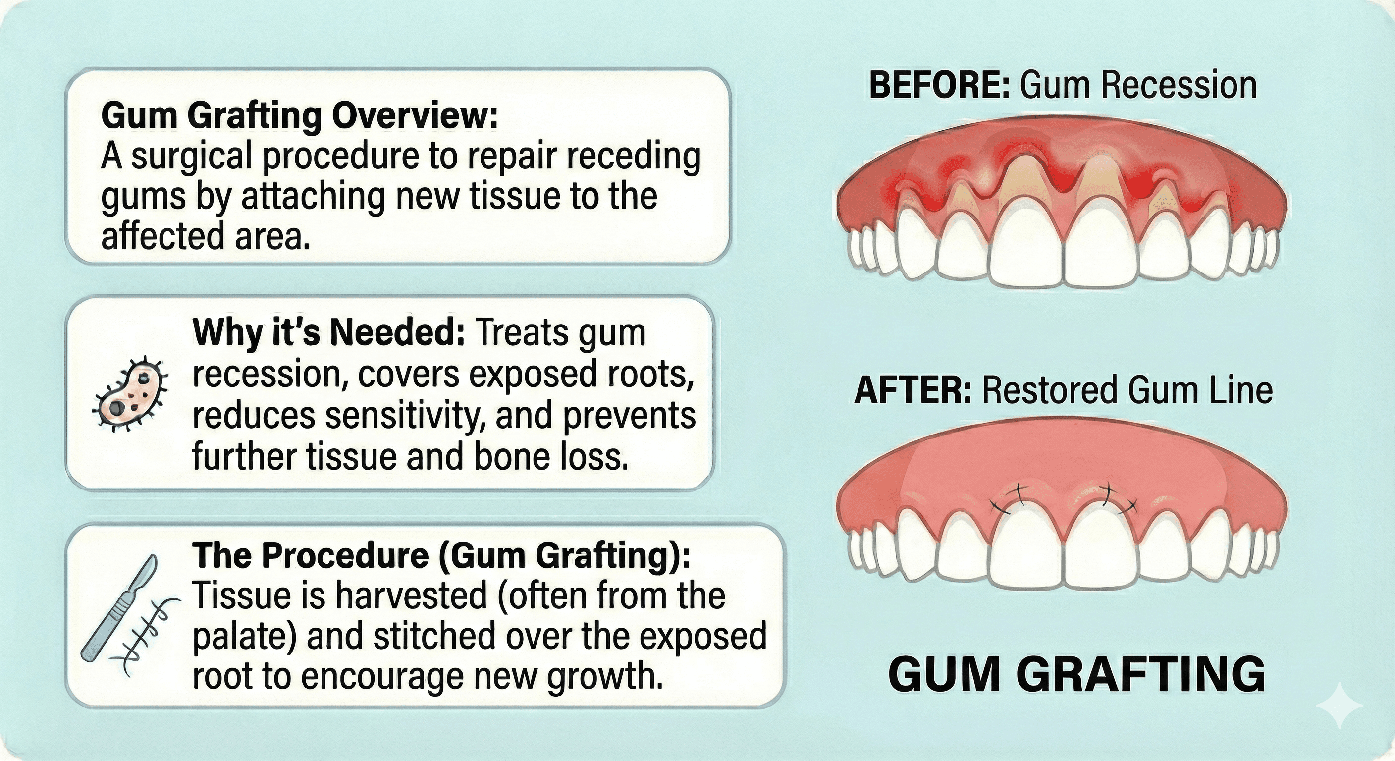 Infographic of gum grafting in North York, ON at Sovrle Dental Clinic describing an overview of the procedure, causes of swollen gums, and how the procedure is performed | Top rated dentist in North York, ON at Sovrle Dental Clinic