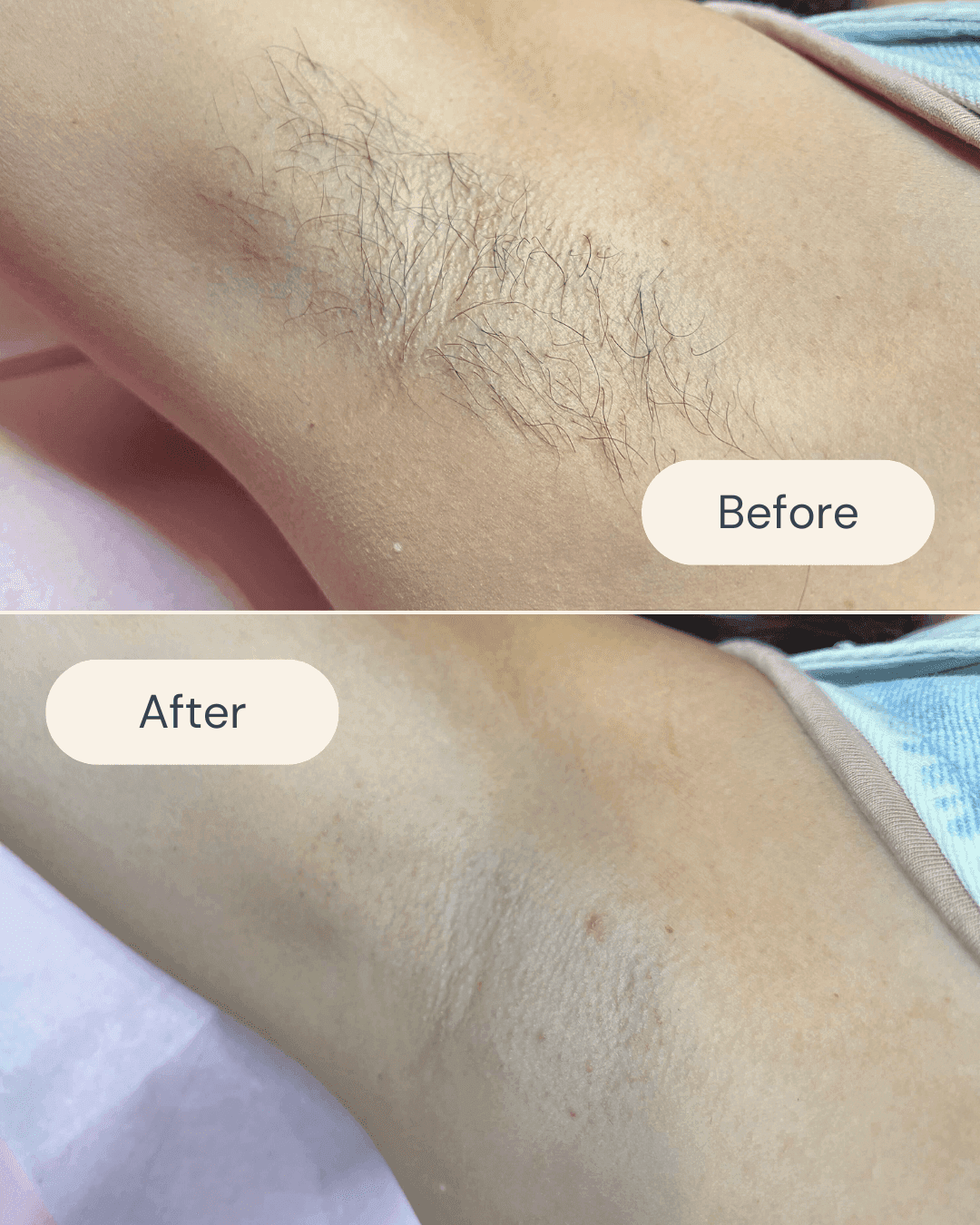 underarm waxing before and after with smooth, hair-free results