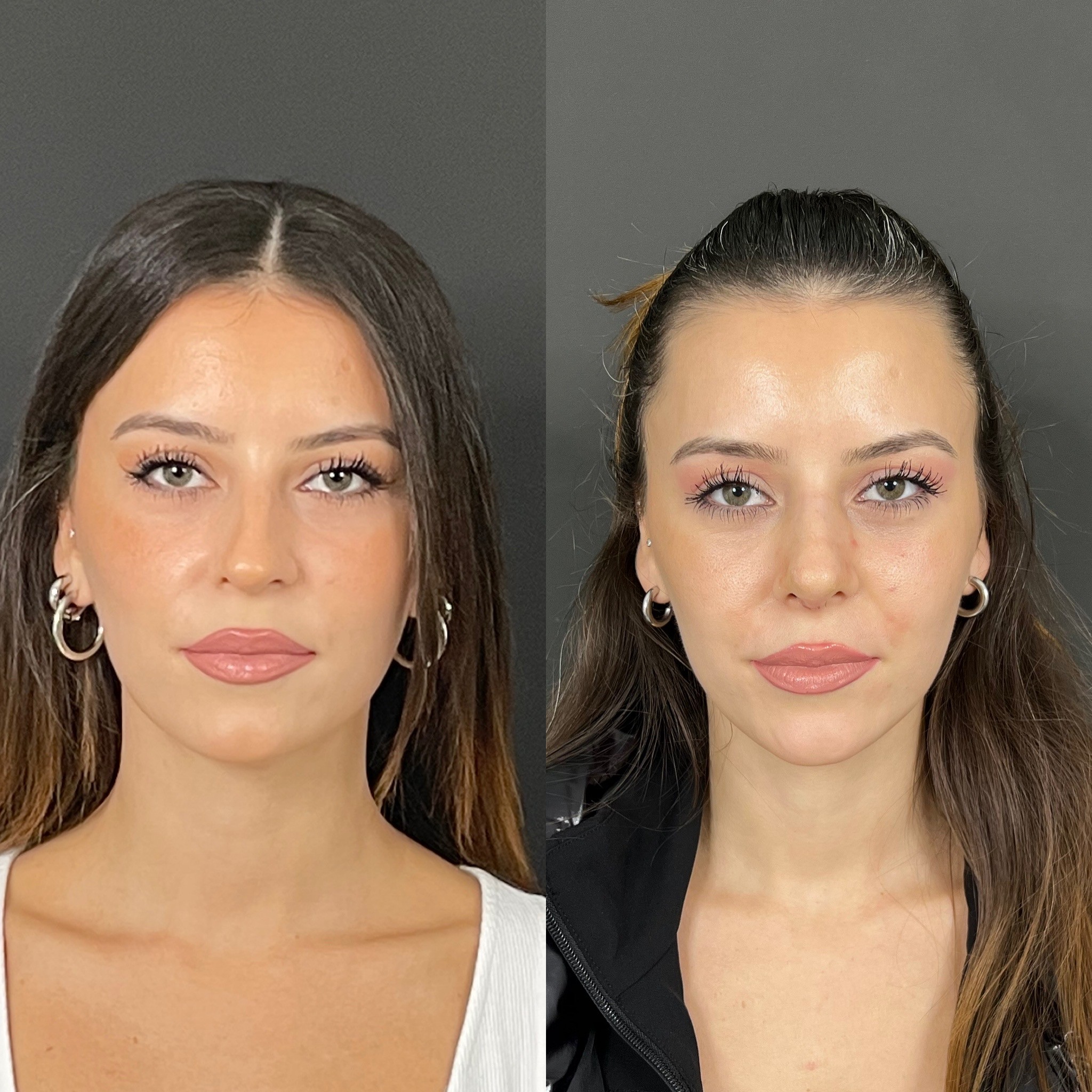 10 days rhinoplasty patient before after front view