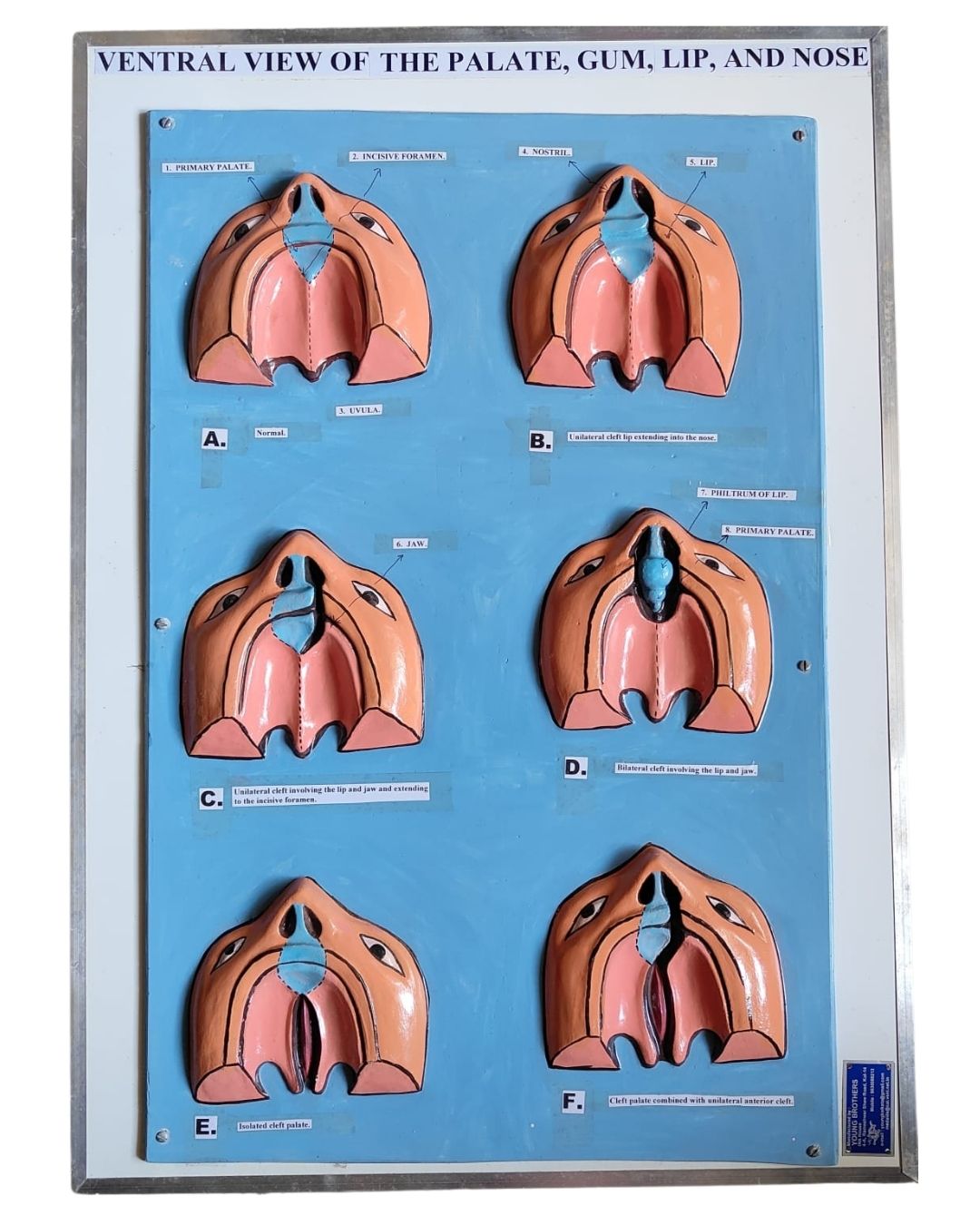 Palate, Gum, Lip & Nose