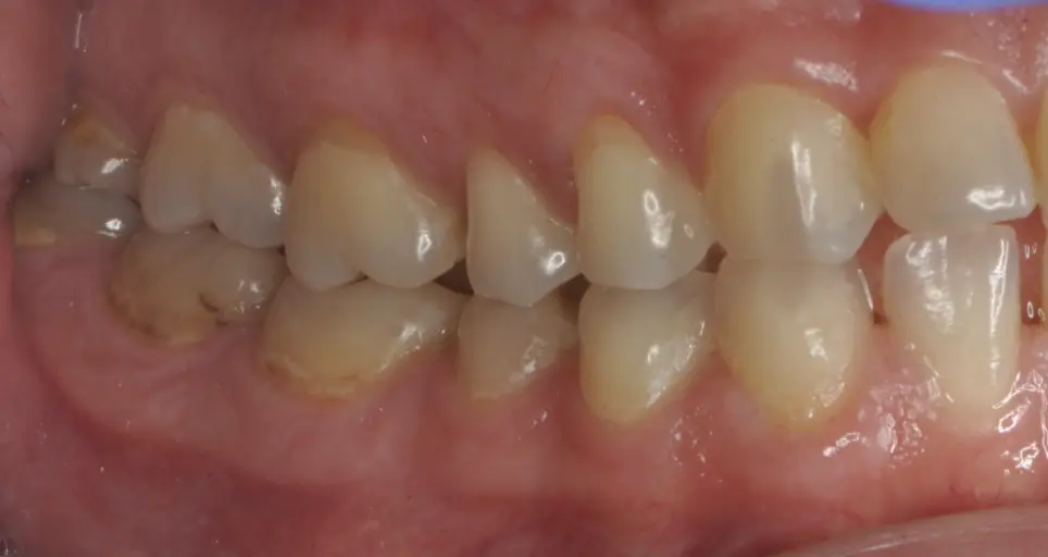 Before ortho treatment