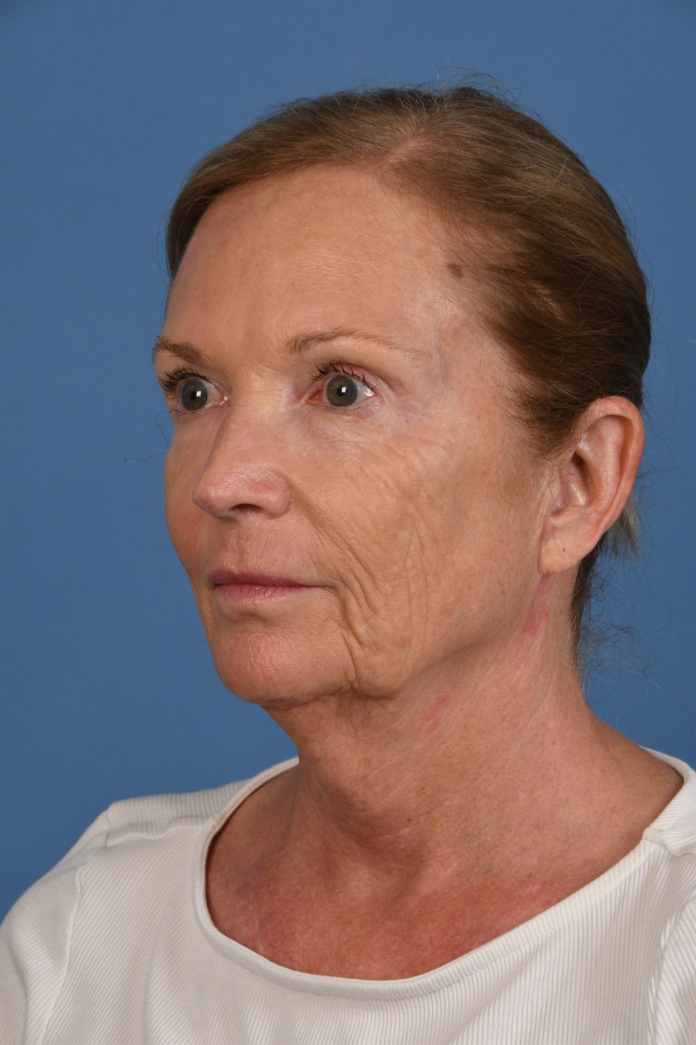 Facelift patient before surgery, three-quarter view, left side