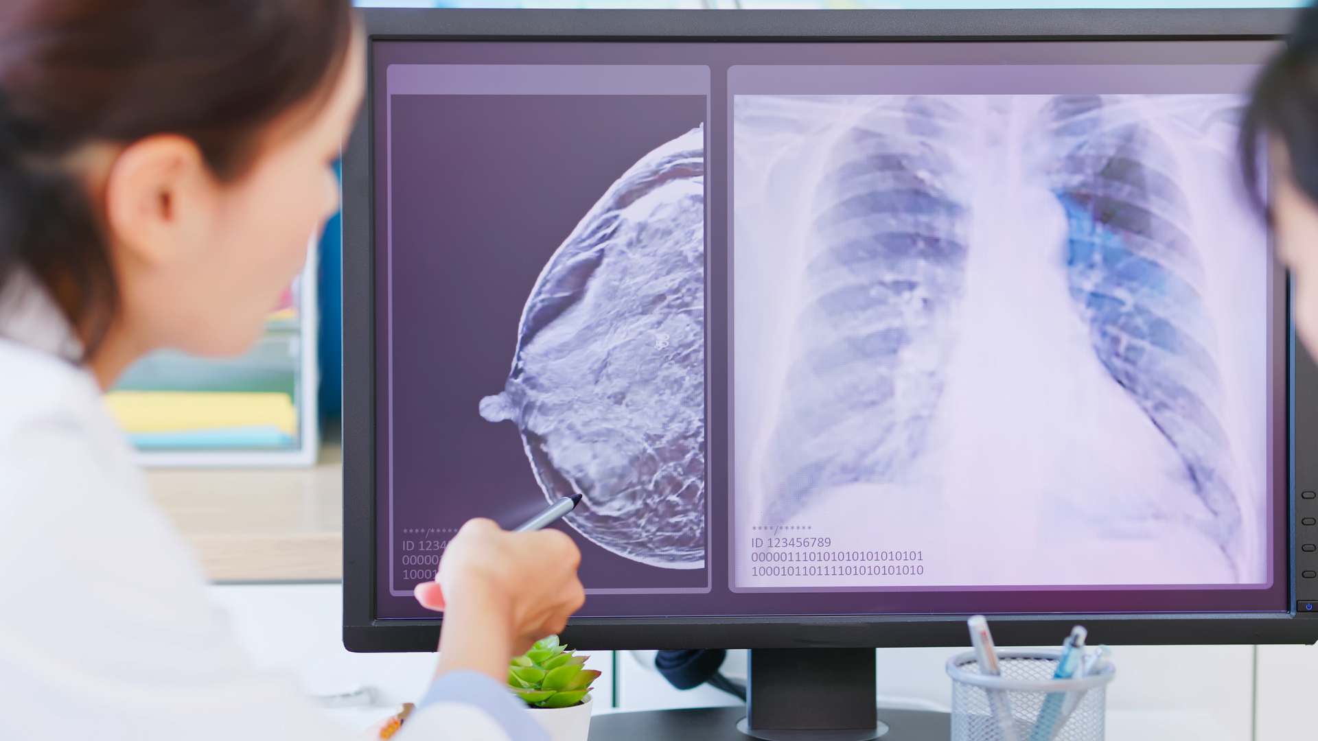 A doctor pointing to a spot on a breast scan on a screen.