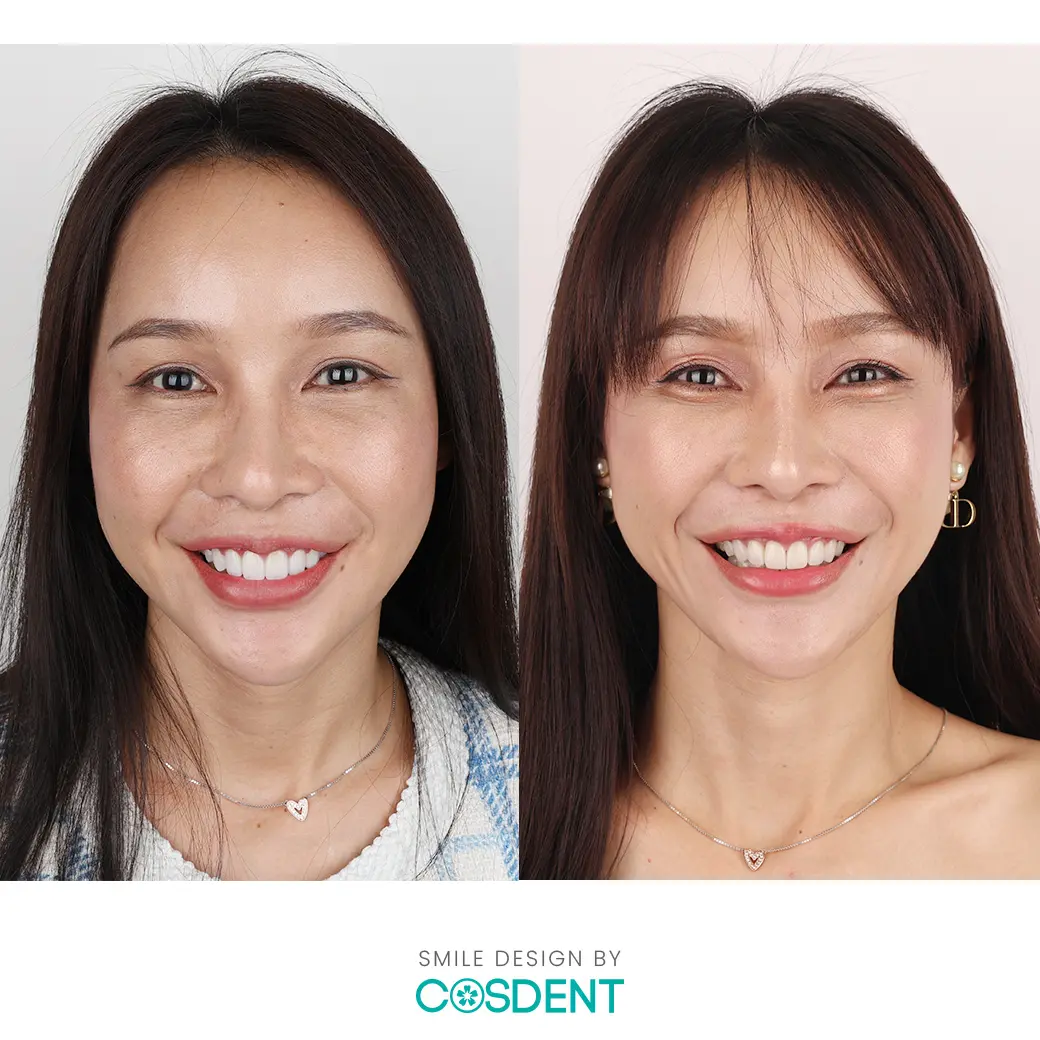 เพ็ญนที บอลลูน รีวิวเคส หมอแจน cosdent smile design