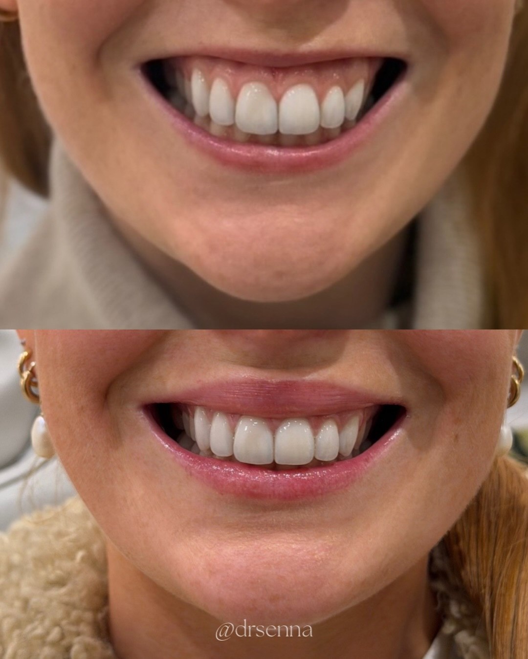 Before and after lip flip treatment