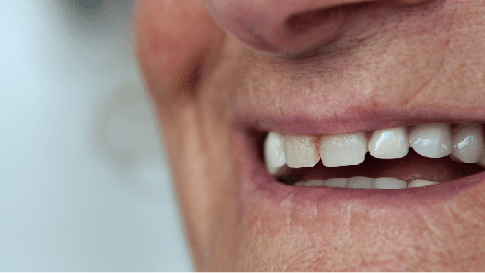 Close-up of person smiling showing teeth.