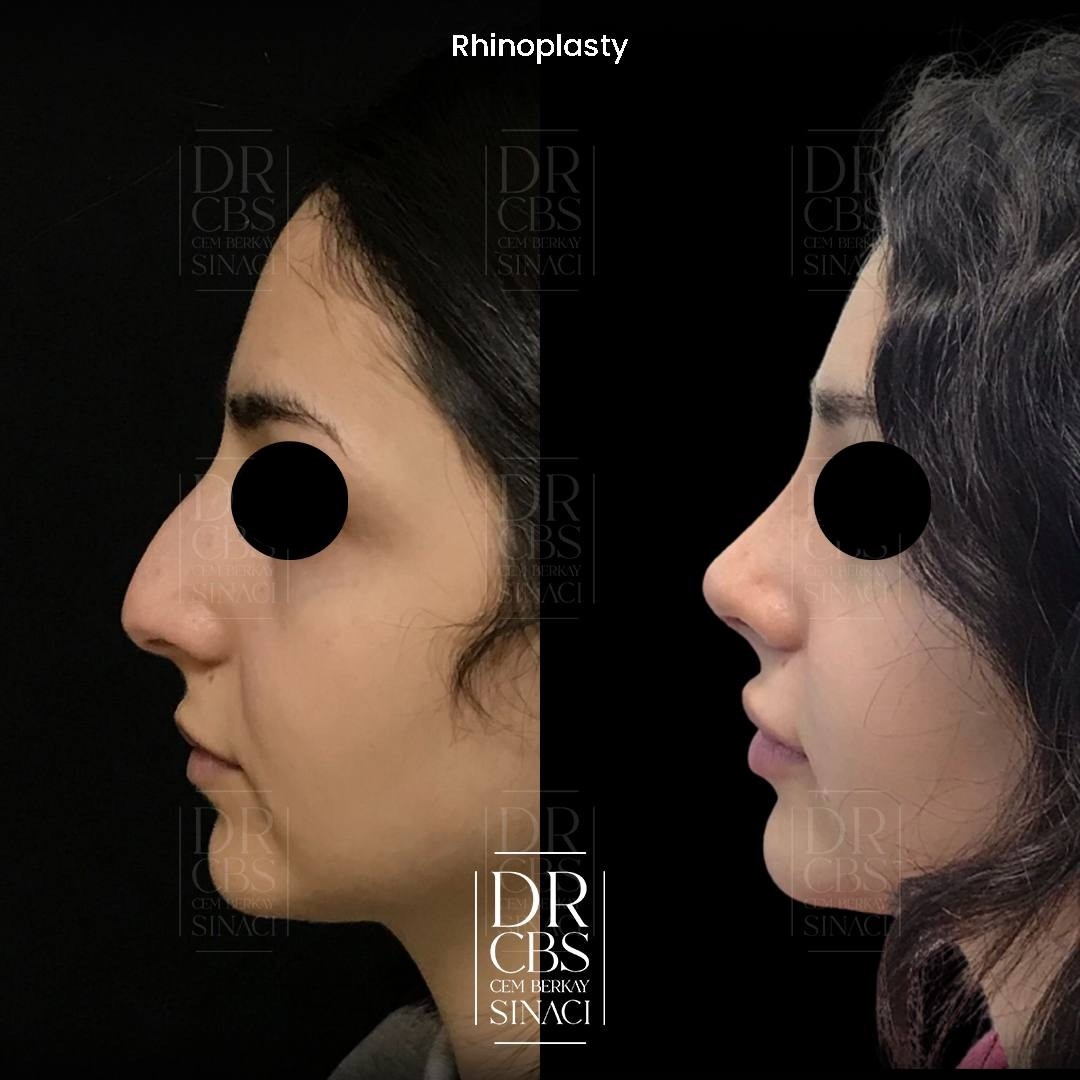 6 months before after ultrasonic rhinoplasty and chin augmentation