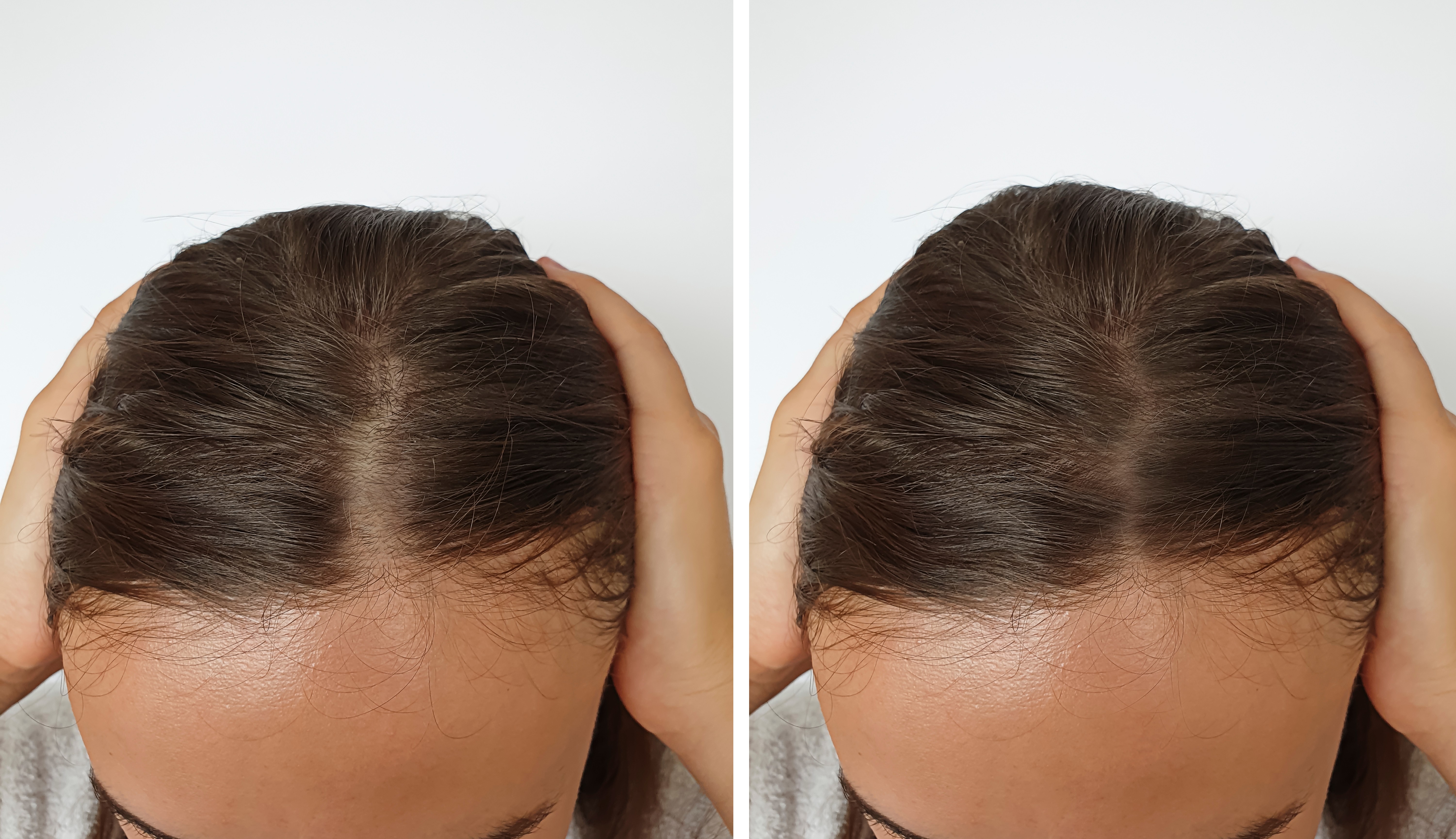 hair grown after hair loss treatment at Bella Medical Centre in Abu Dhabi