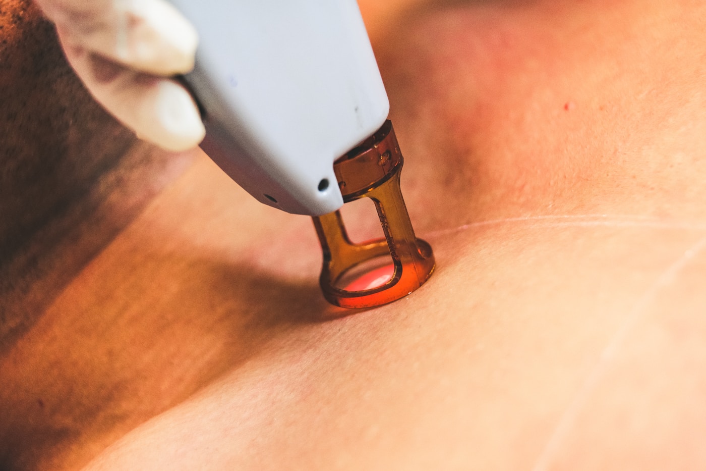 IPL light-based treatment being performed in a dermatology clinic