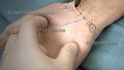 Carpal tunnel release