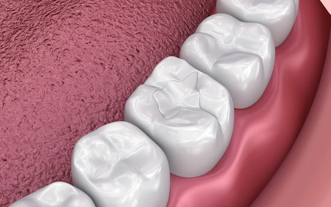dental fillings