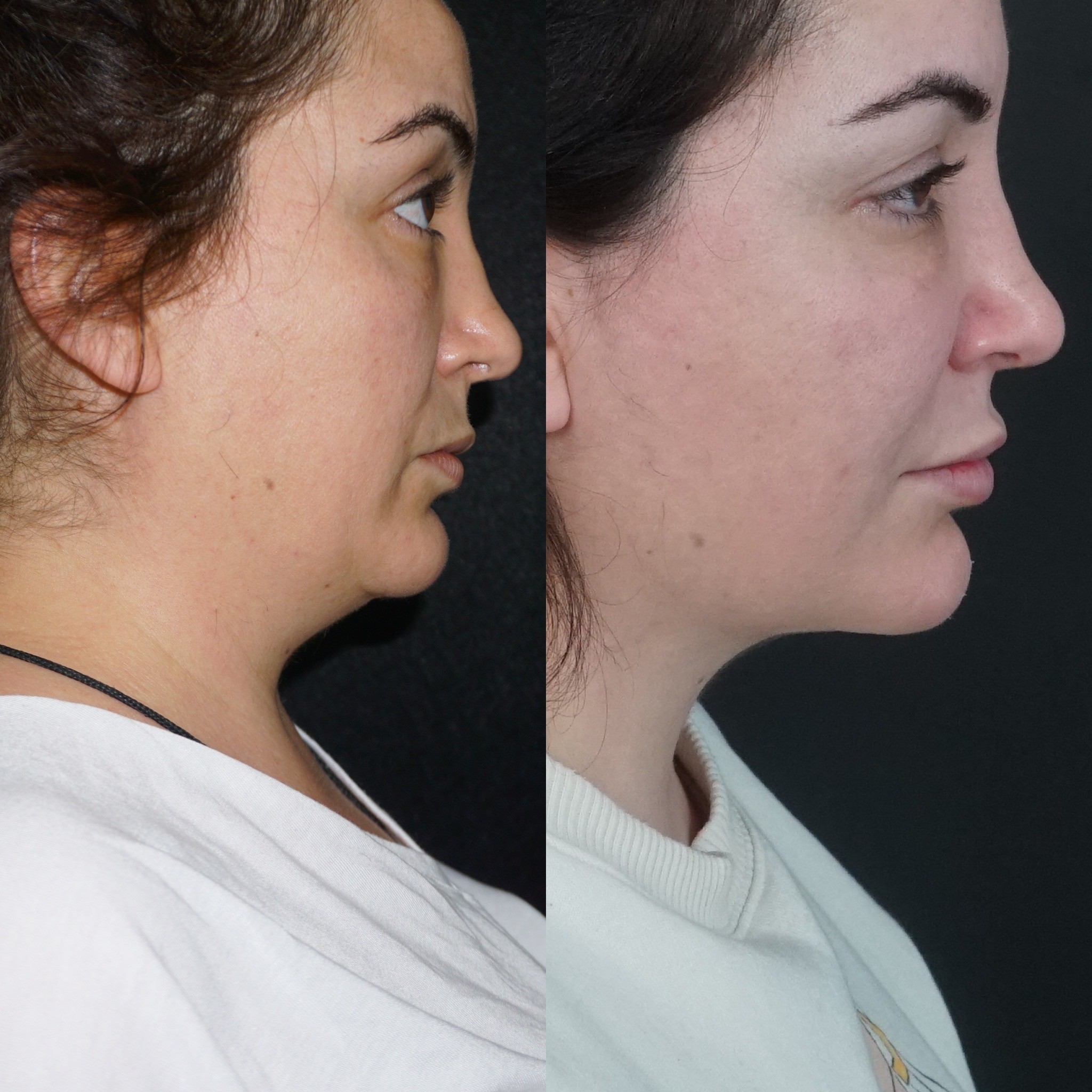 5 month post-surgery buccal fat removal before after with chin liposuction