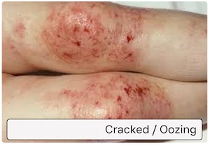 Cracked / oozing