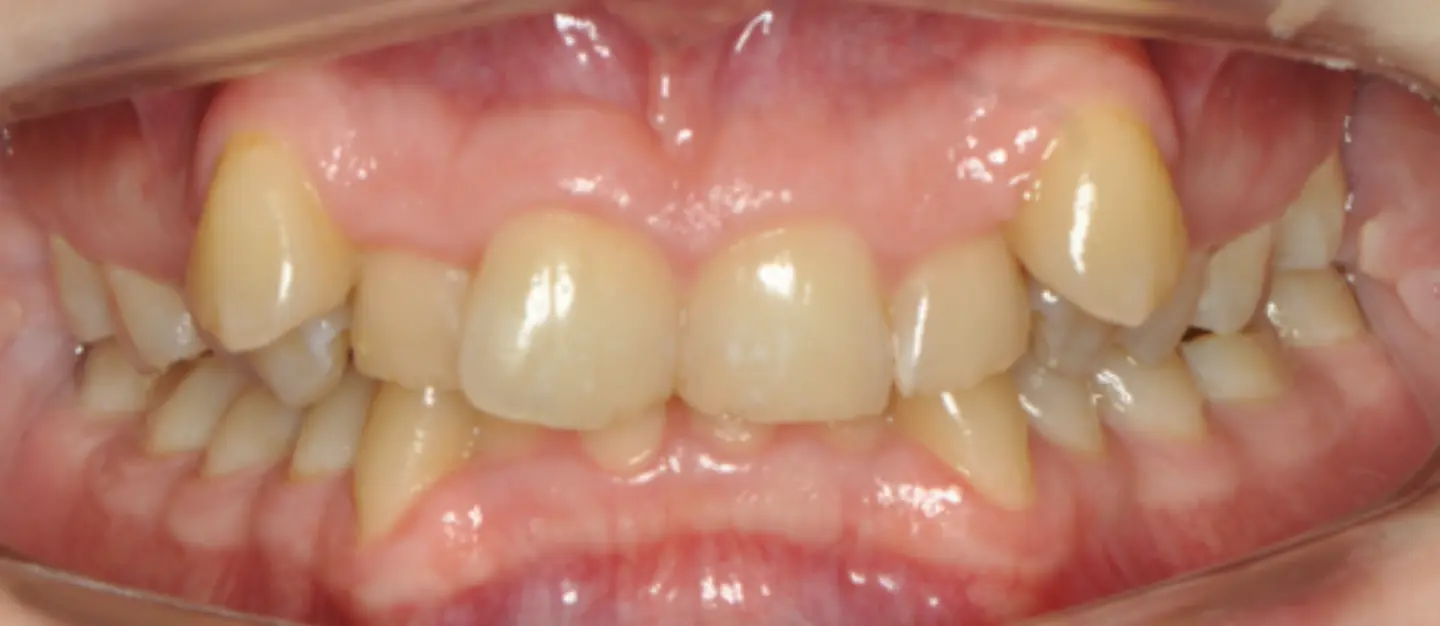 Prima e dopo il trattamento ortodontico funzionale, senza estrazione dei denti premolari