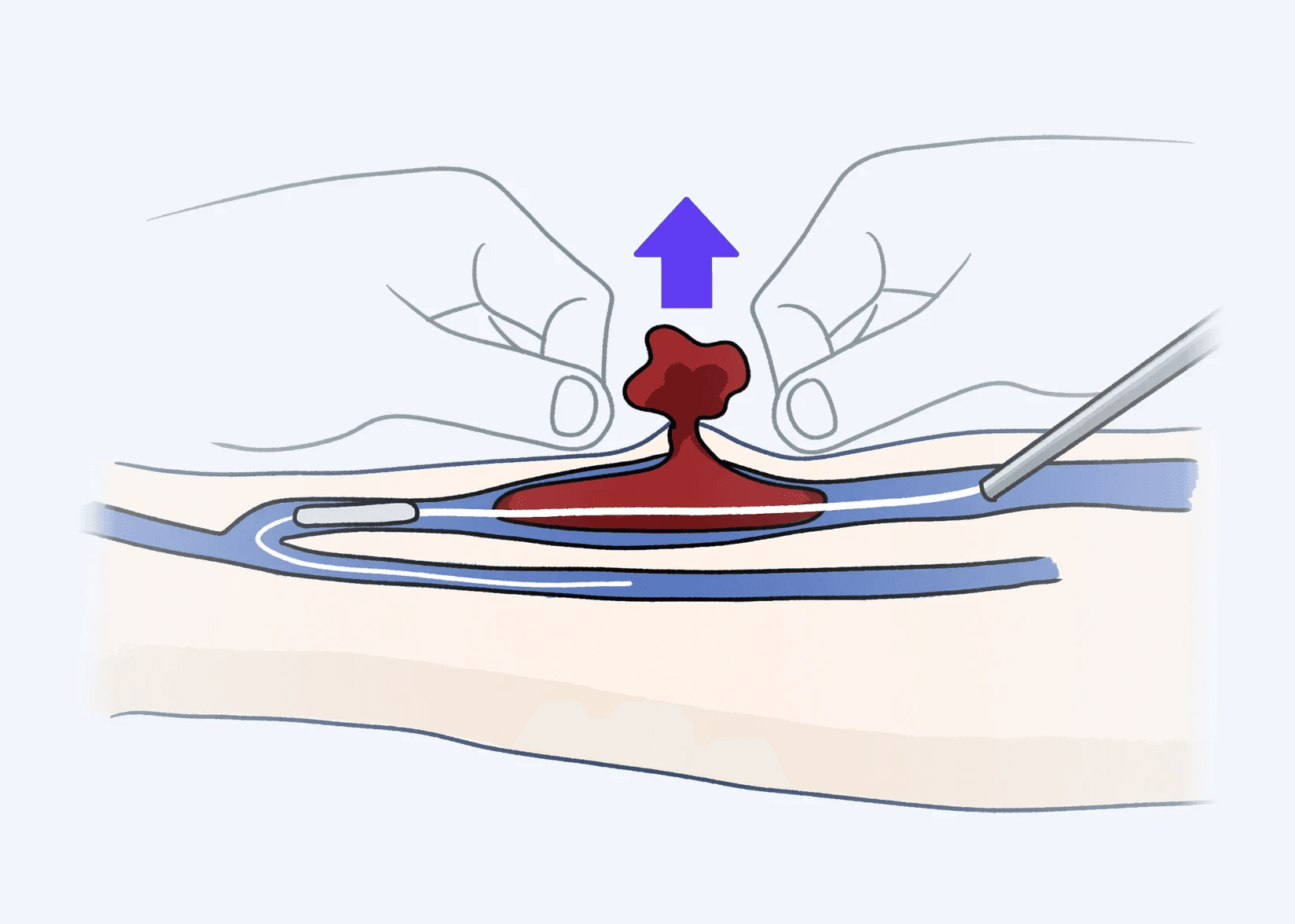 혈전제거술 일러스트