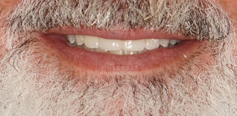 After ortho treatment