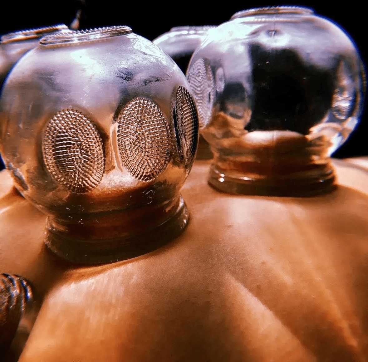 Close-up of glass suction cups during a cupping therapy.