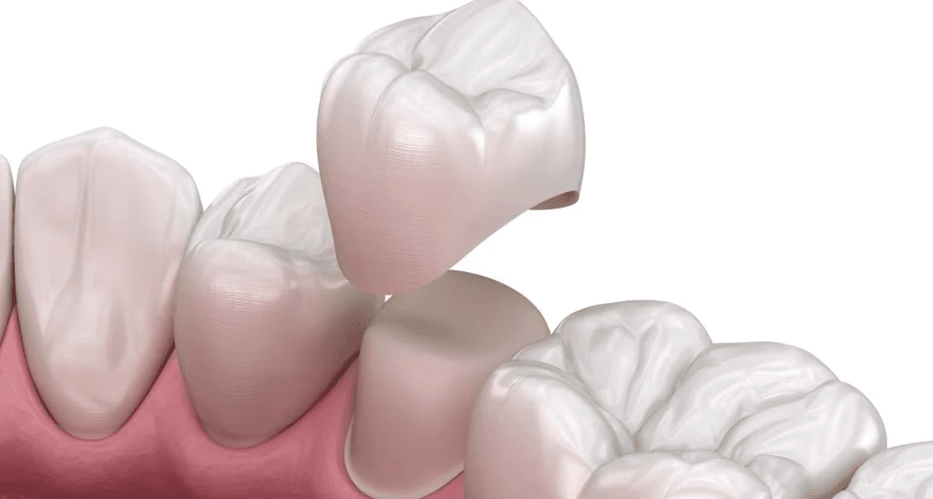 Perfected Smiles Same-Day Dental Crown