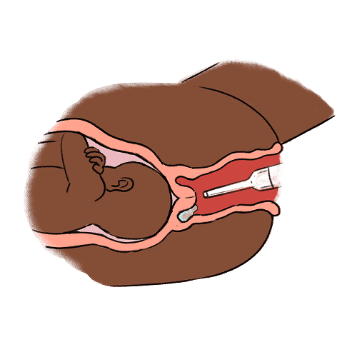 An illustration showing a cross-section of a baby inside the womb, a cervix, a vagina, and a syringe administering prostaglandin gel at the posterior part of the cervix inside the vagina.