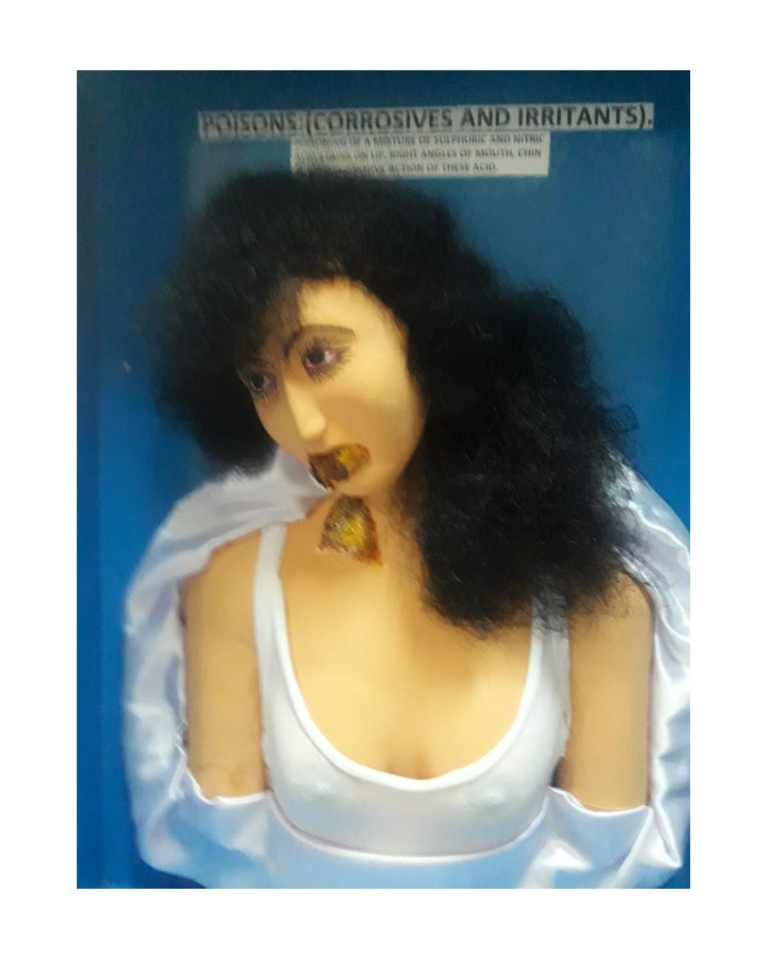 Corrosive / Irritant Poisoning (Acid Injury on Mouth & Chin)