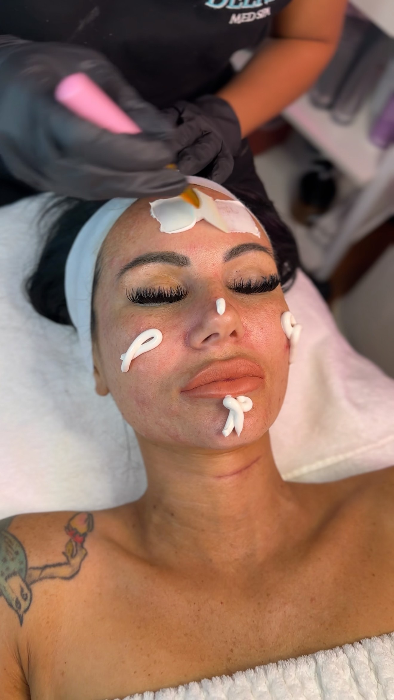botox-treatment