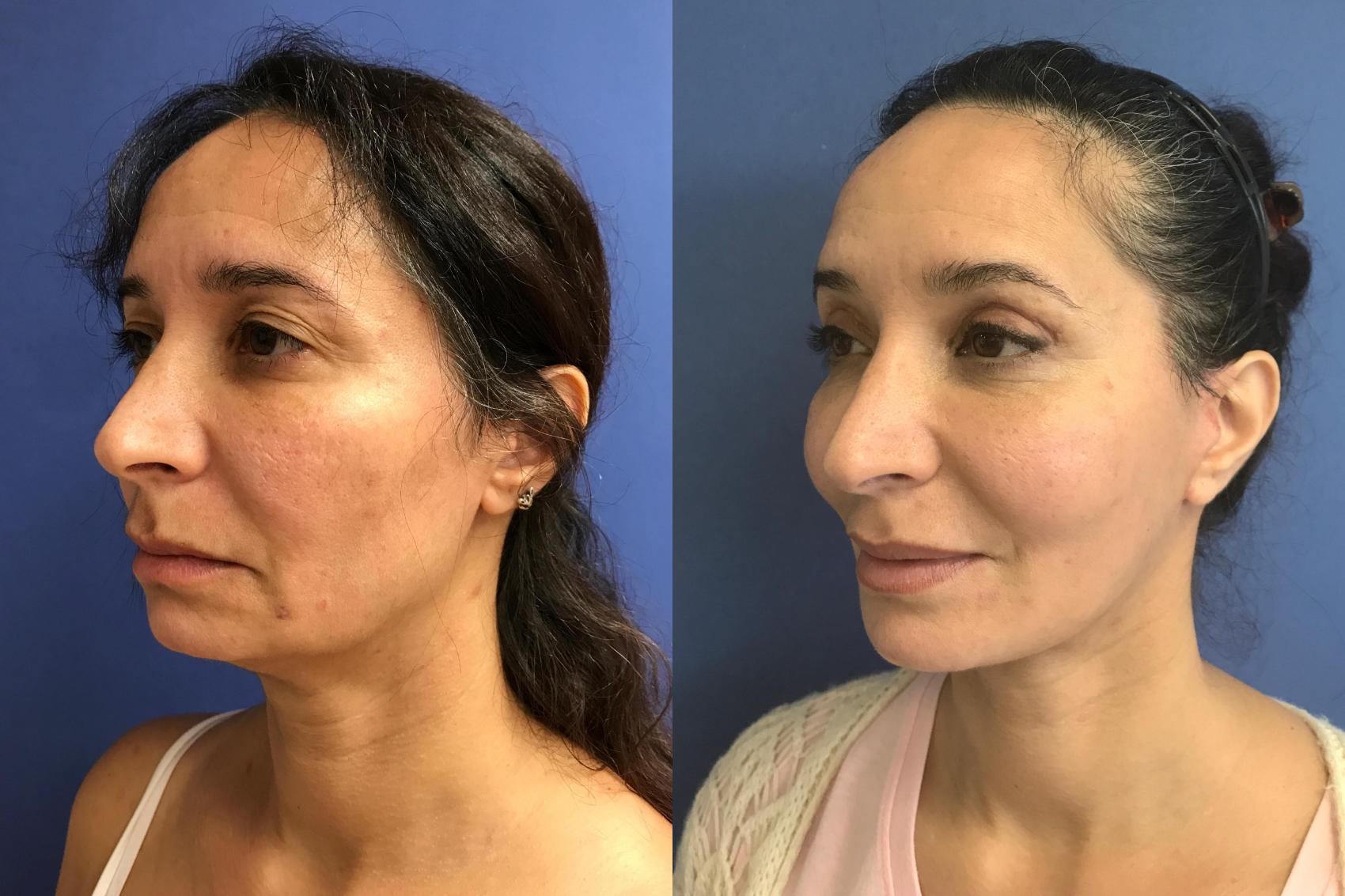 face lift of a person - How to Fix Ozempic Face Naturally