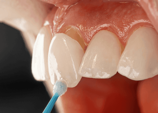 a tooth with a blue toothbrush in it