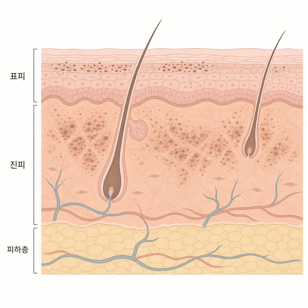 표피에 얕게 자리한 색소와 진피 쪽으로 내려간 색소는 보이는 느낌이 달라요.