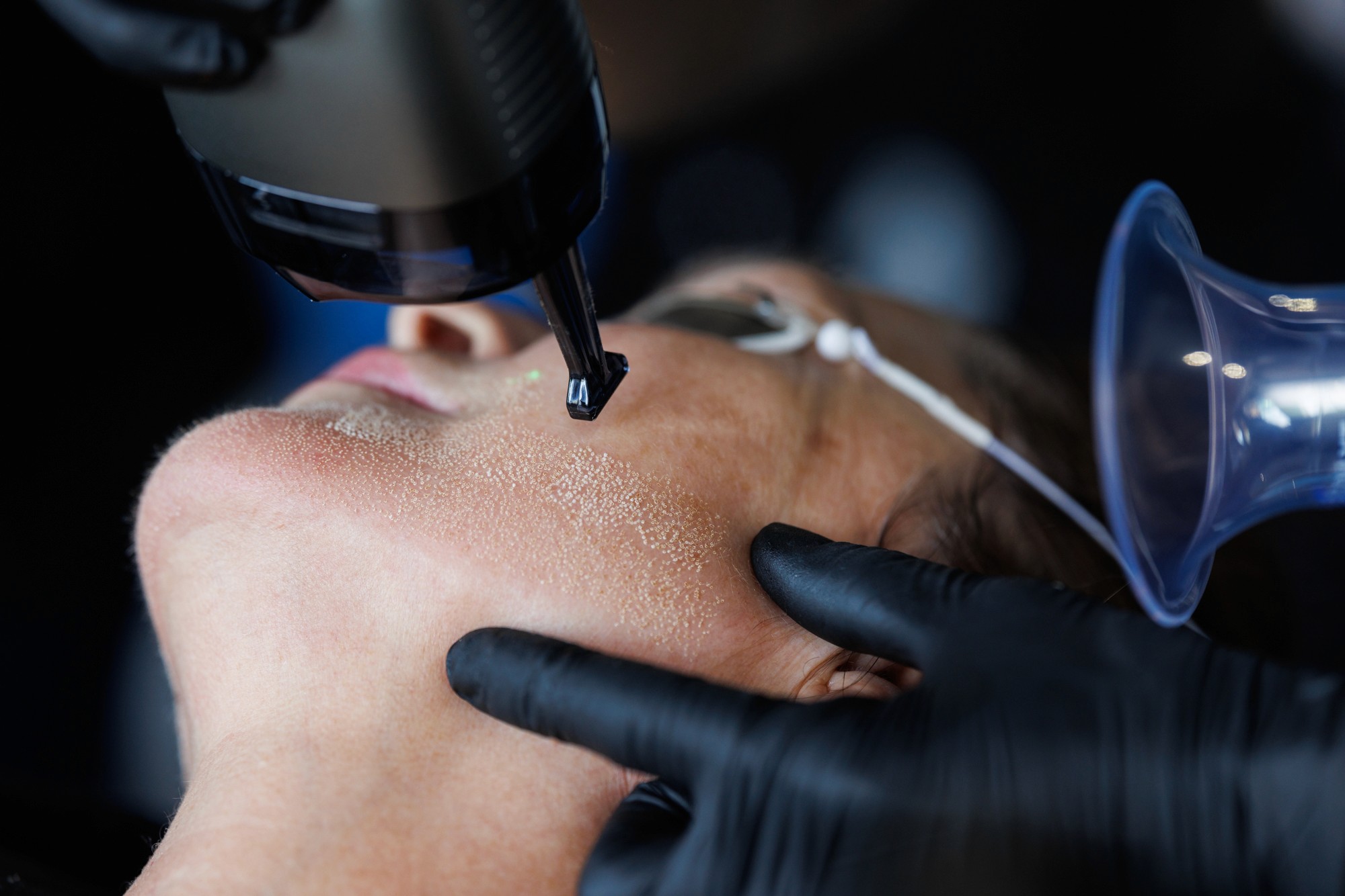 Dr Alex appliquant une solution sur le visage de la patiente en vue du traitement